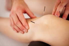 Dry Needling Townsville | Tpm Physiotherapy